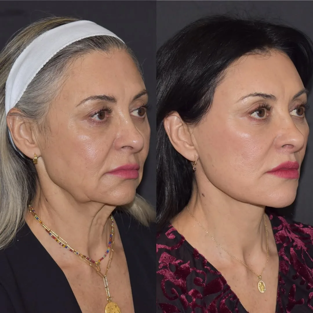 Before and after deep plane facelift — 52-year-old woman, oblique right view, 7mo post-op by Dr. Yula Indeyeva