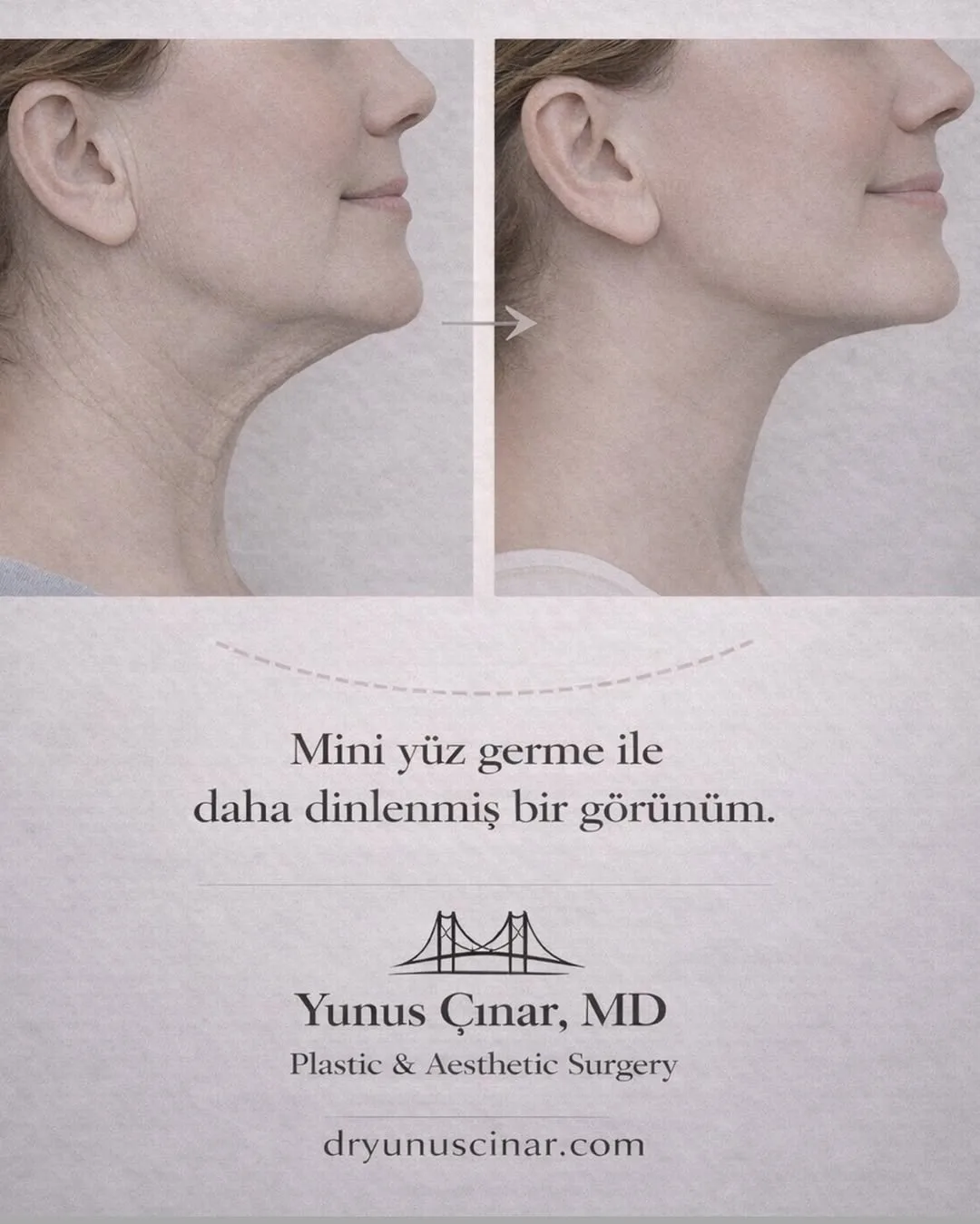 Before and after — Dr. Yunus Cinar
