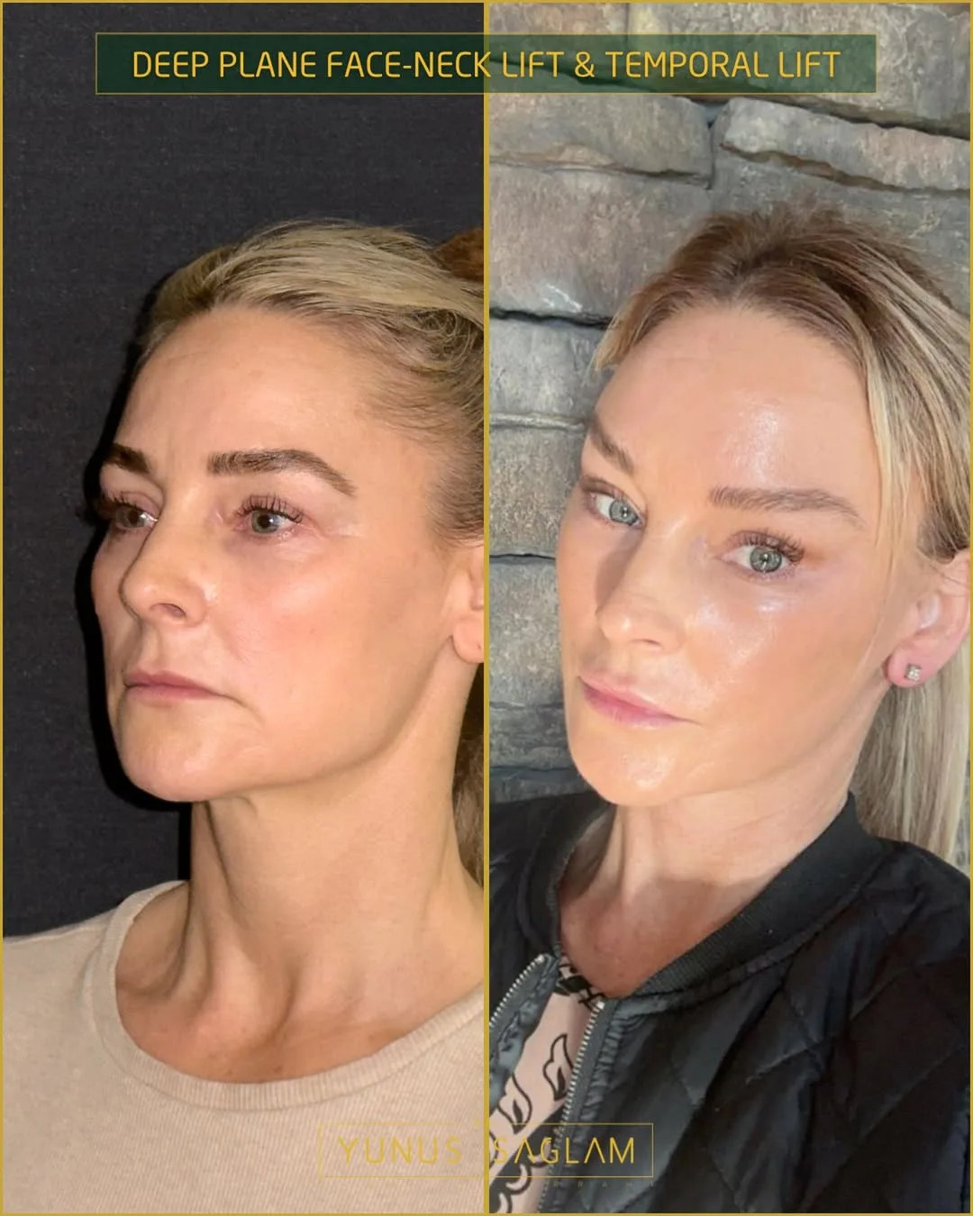 Before and after — Dr. Yunus Sağlam