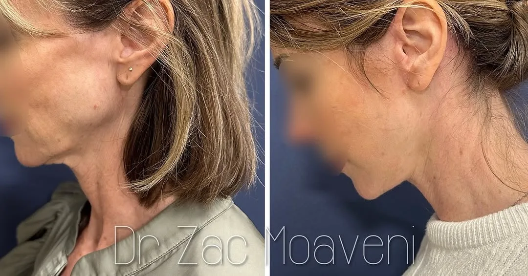 Before and after deep plane facelift — 45-year-old woman, oblique left view, 6mo post-op by Dr. Zac Moaveni