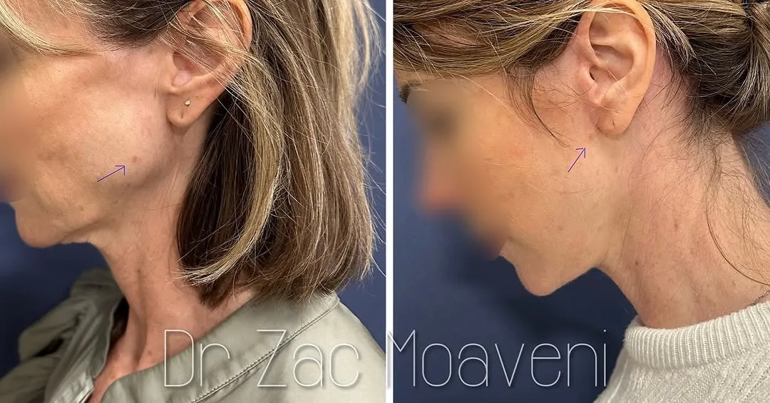 Before and after deep plane facelift — 55-year-old woman, left profile view, 6mo post-op by Dr. Zac Moaveni
