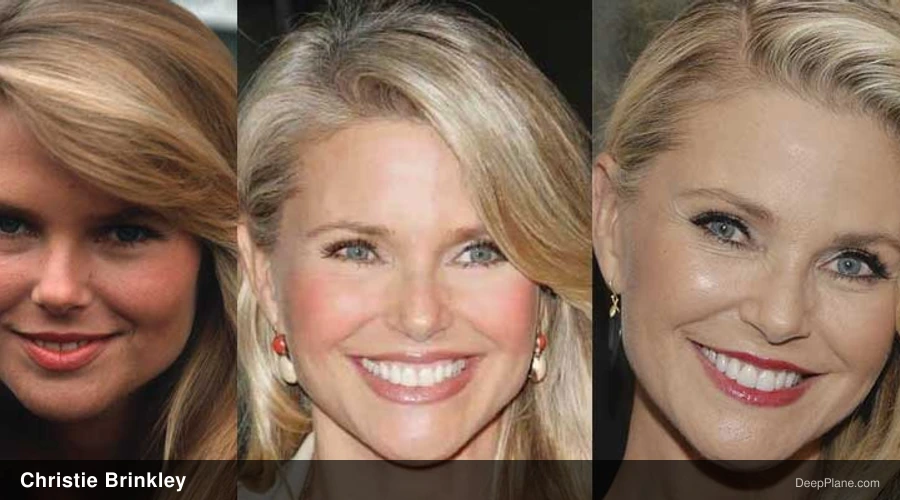 Christie Brinkley deep plane facelift before and after comparison