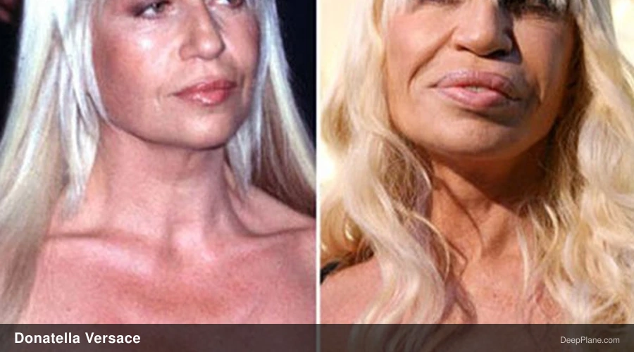 Donatella Versace before and after comparison