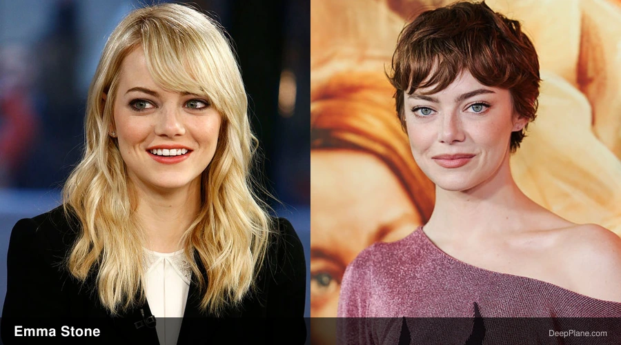 Emma Stone deep plane facelift before and after comparison