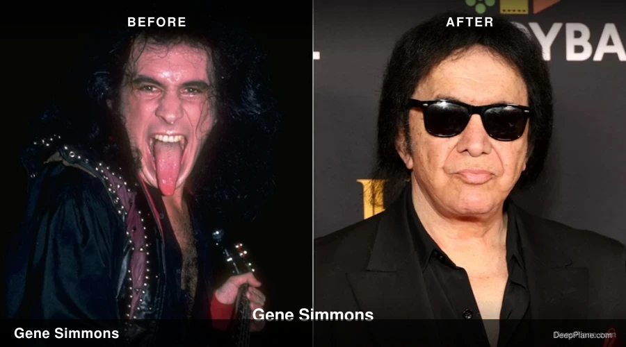 Gene Simmons deep plane facelift before and after comparison