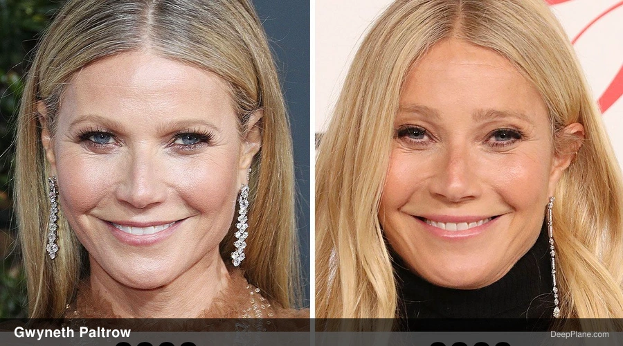 Gwyneth Paltrow deep plane facelift before and after comparison