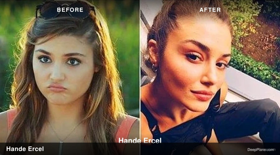 Hande Erçel deep plane facelift before and after comparison