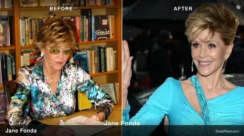 Jane Fonda deep plane facelift before and after comparison