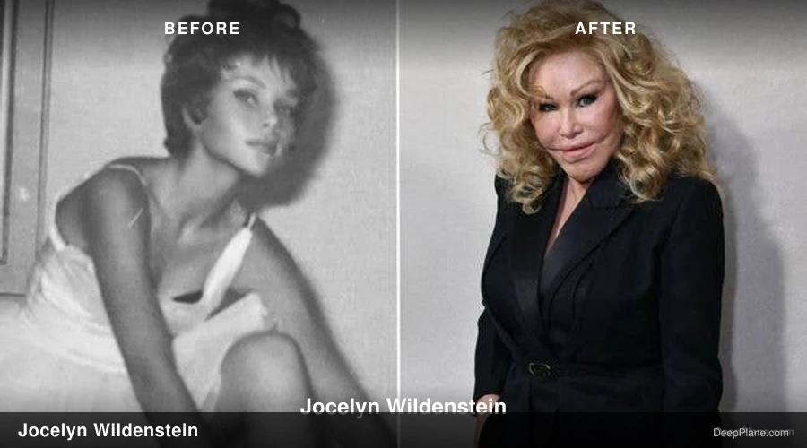 Jocelyn Wildenstein deep plane facelift before and after comparison