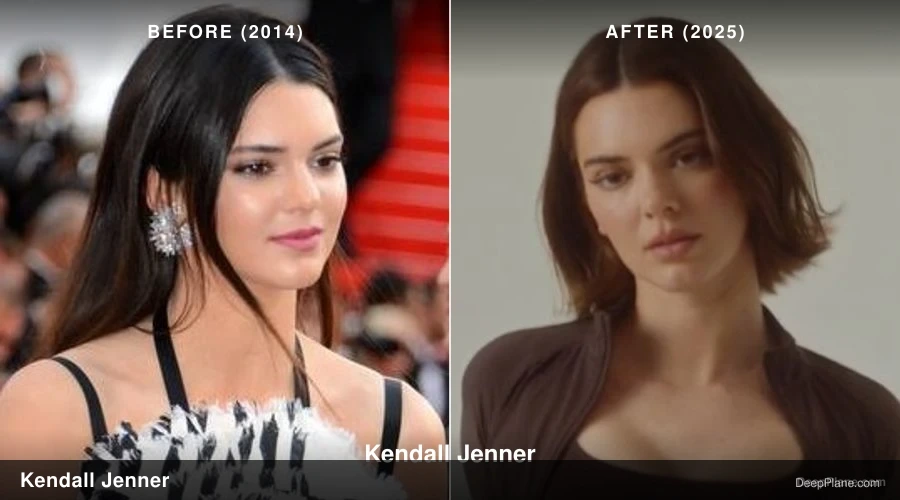 Kendall Jenner deep plane facelift before and after comparison