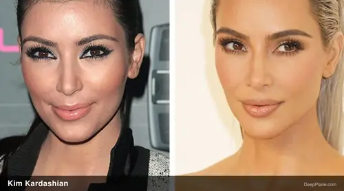 Kim Kardashian deep plane facelift before and after comparison