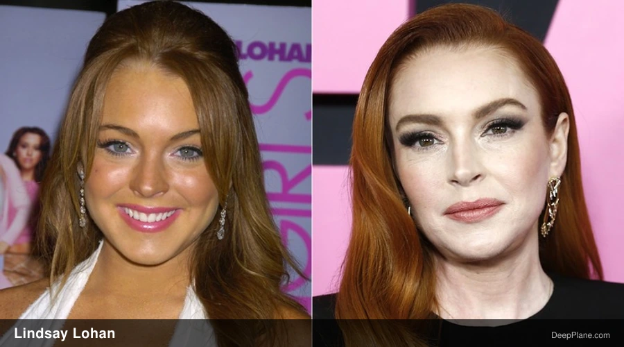 Lindsay Lohan deep plane facelift before and after comparison