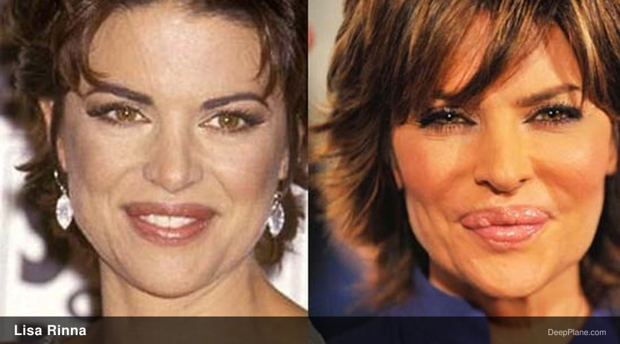 Lisa Rinna before and after comparison