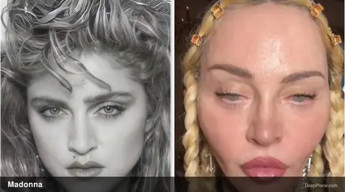 Madonna deep plane facelift before and after comparison