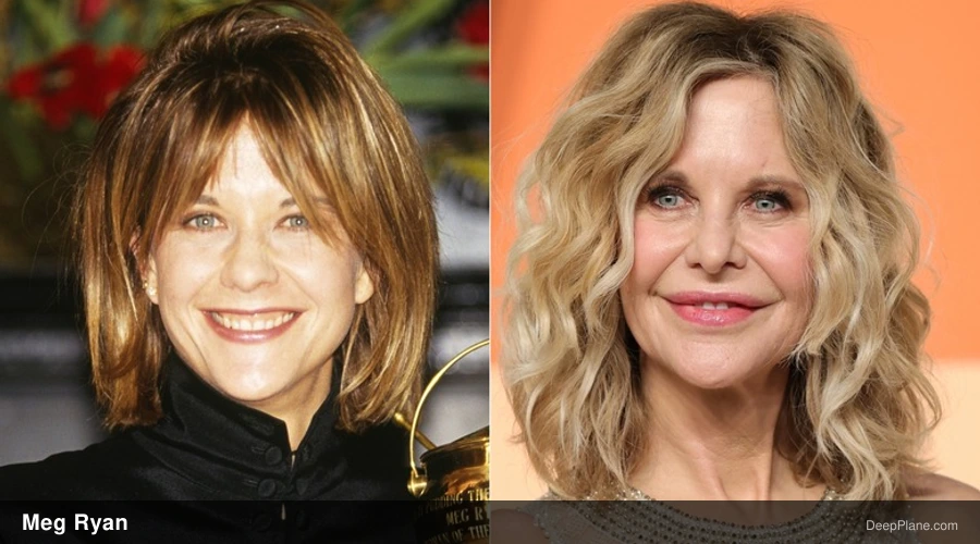 Meg Ryan deep plane facelift before and after comparison