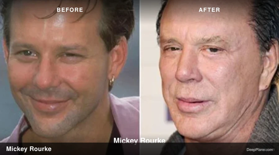 Mickey Rourke deep plane facelift before and after comparison
