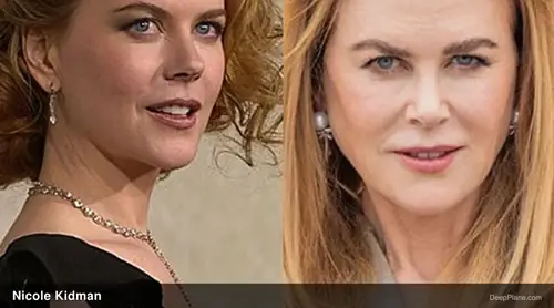 Nicole Kidman deep plane facelift before and after comparison