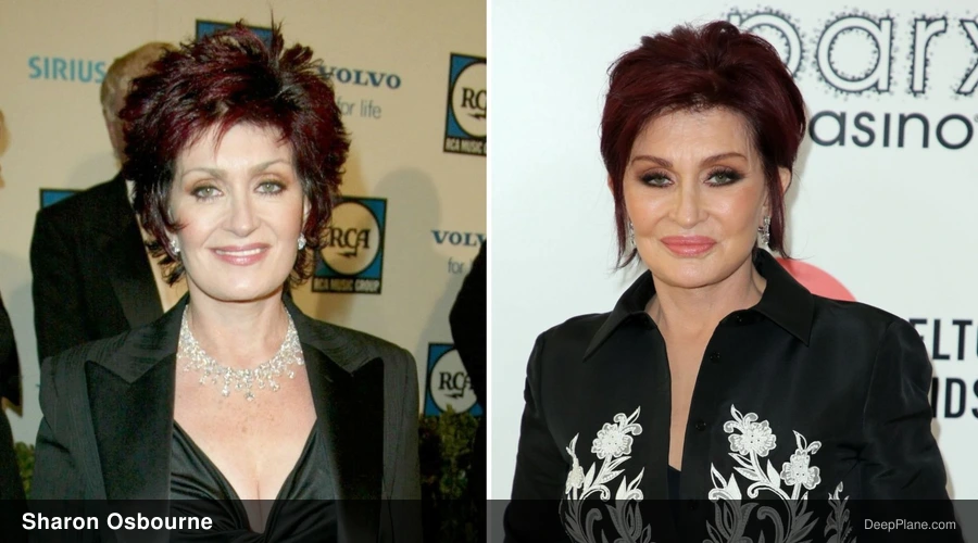 Sharon Osbourne deep plane facelift before and after comparison