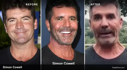 Simon Cowell deep plane facelift before and after comparison