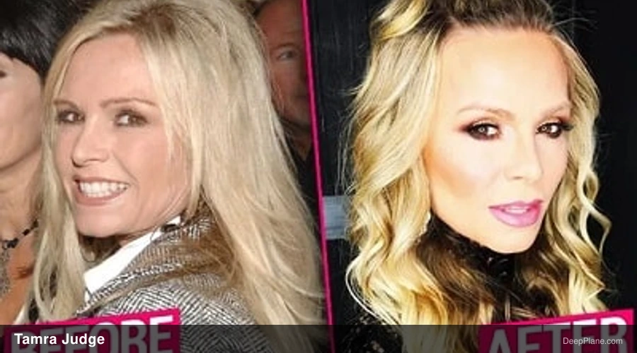 Tamra Judge deep plane facelift before and after comparison