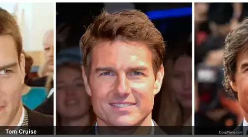 Tom Cruise deep plane facelift before and after comparison