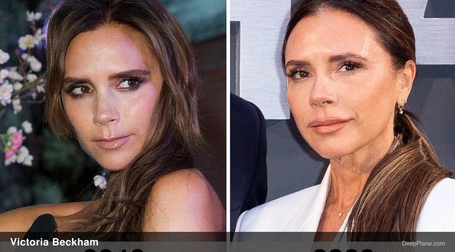 Victoria Beckham deep plane facelift before and after comparison