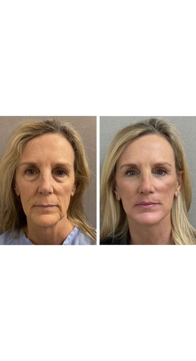 Avant & Après - Deep Plane Facelift par Dr. Keshav Magge