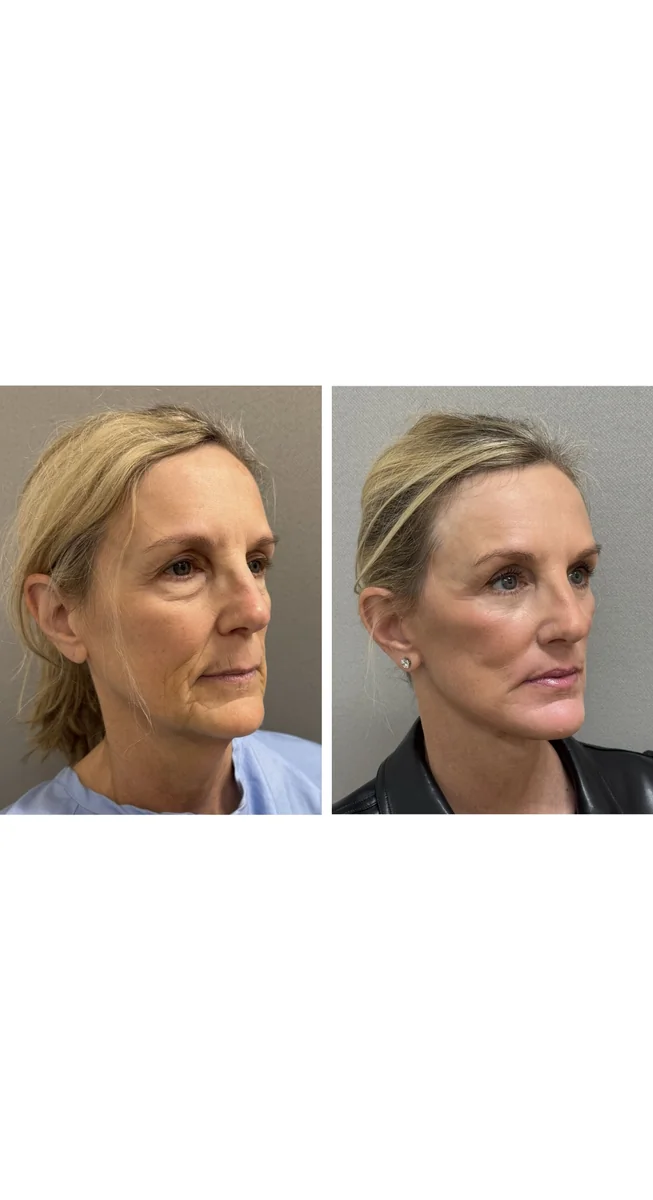 Avant & Après - Deep Plane Facelift par Dr. Keshav Magge