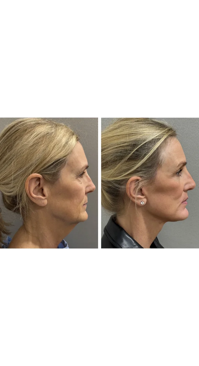 Avant & Après - Deep Plane Facelift par Dr. Keshav Magge