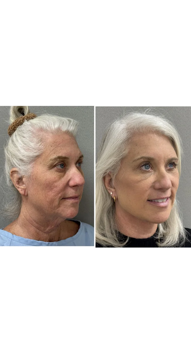 Avant & Après - Deep Plane Facelift par Dr. Keshav Magge
