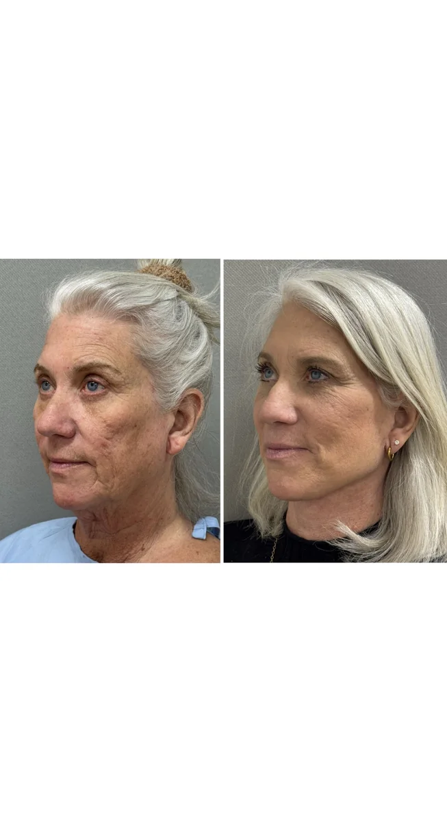 Avant & Après - Deep Plane Facelift par Dr. Keshav Magge