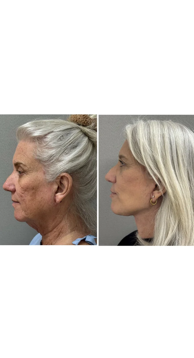 Avant & Après - Deep Plane Facelift par Dr. Keshav Magge