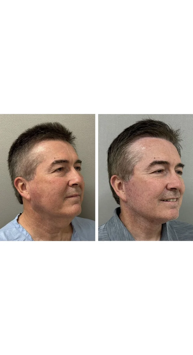 Avant & Après - Deep Plane Facelift par Dr. Keshav Magge