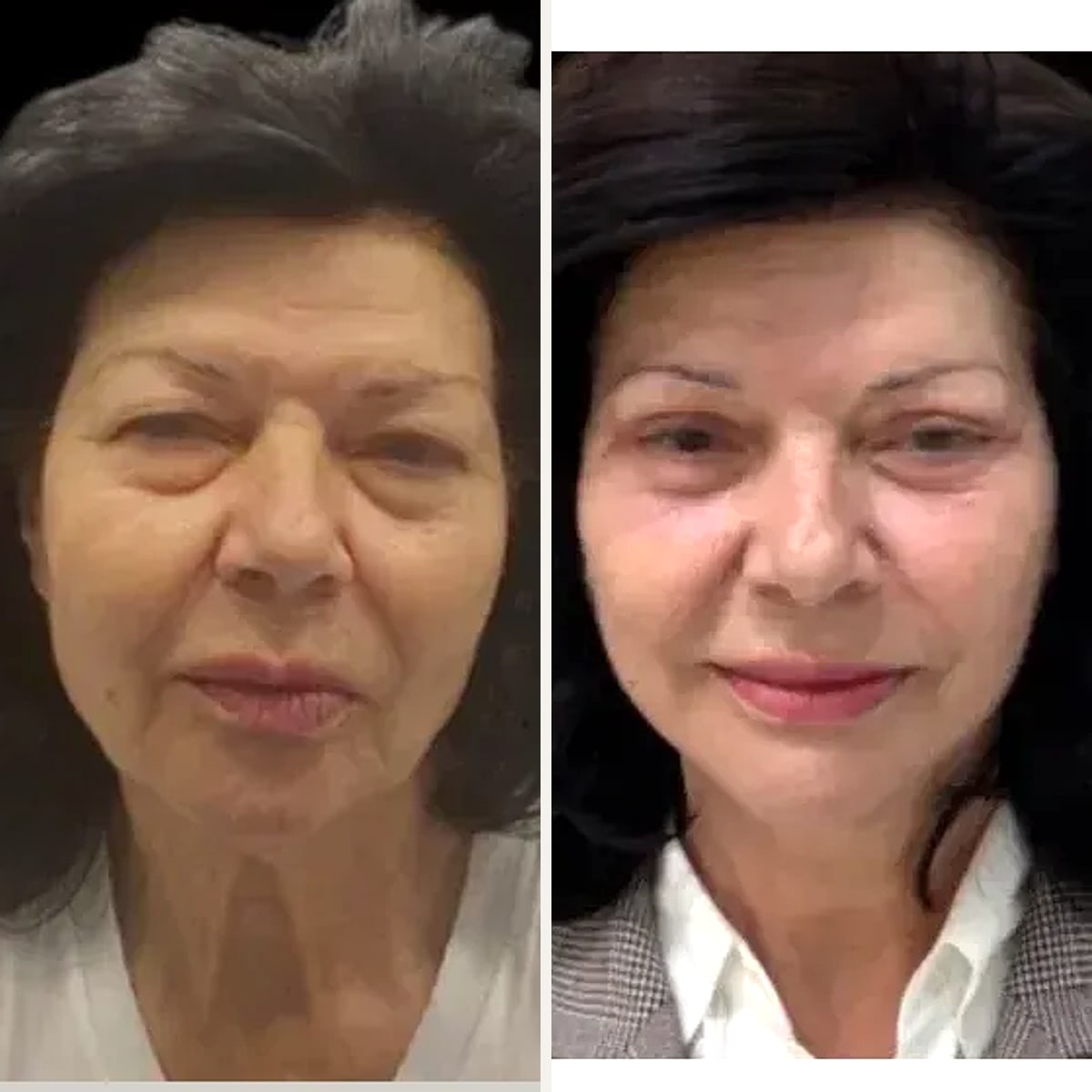 Before and after: Prof. Dr. Ioannis Liapakis