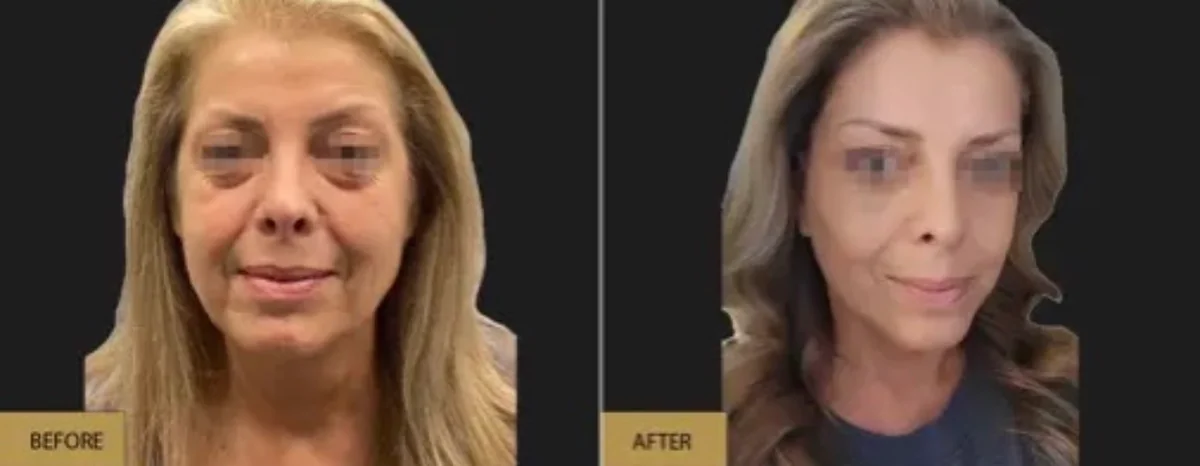 Before and after — Prof. Dr. Ioannis Liapakis