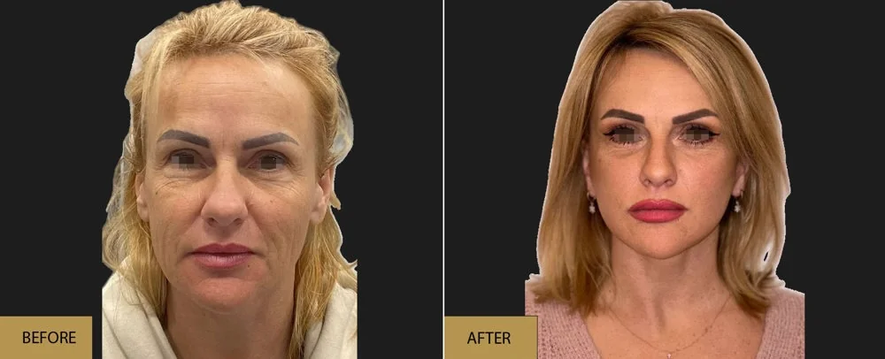 Before and after — Prof. Dr. Ioannis Liapakis