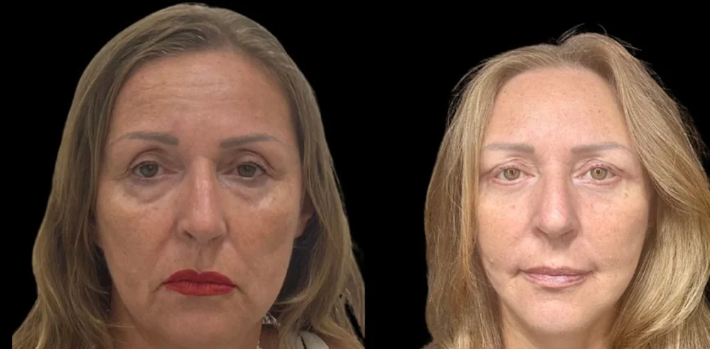 Before and after — Prof. Dr. Ioannis Liapakis