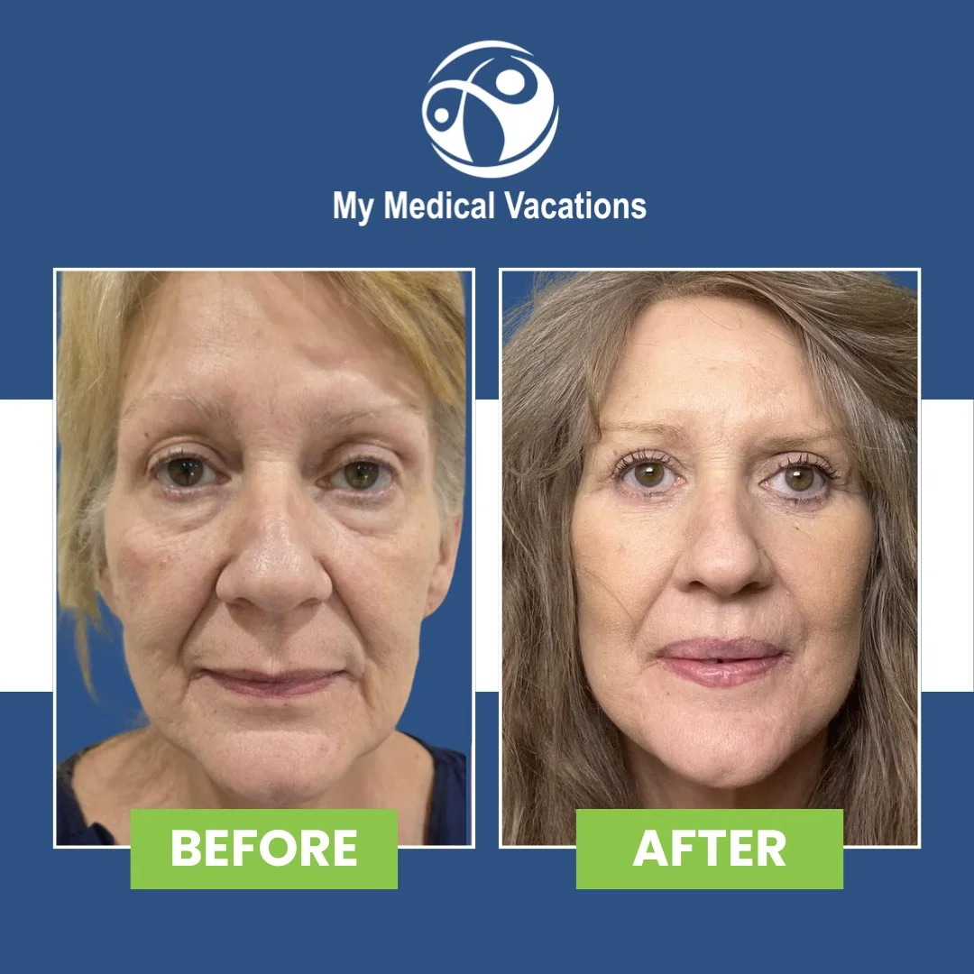 Before and after — Dr. Andres Jurado