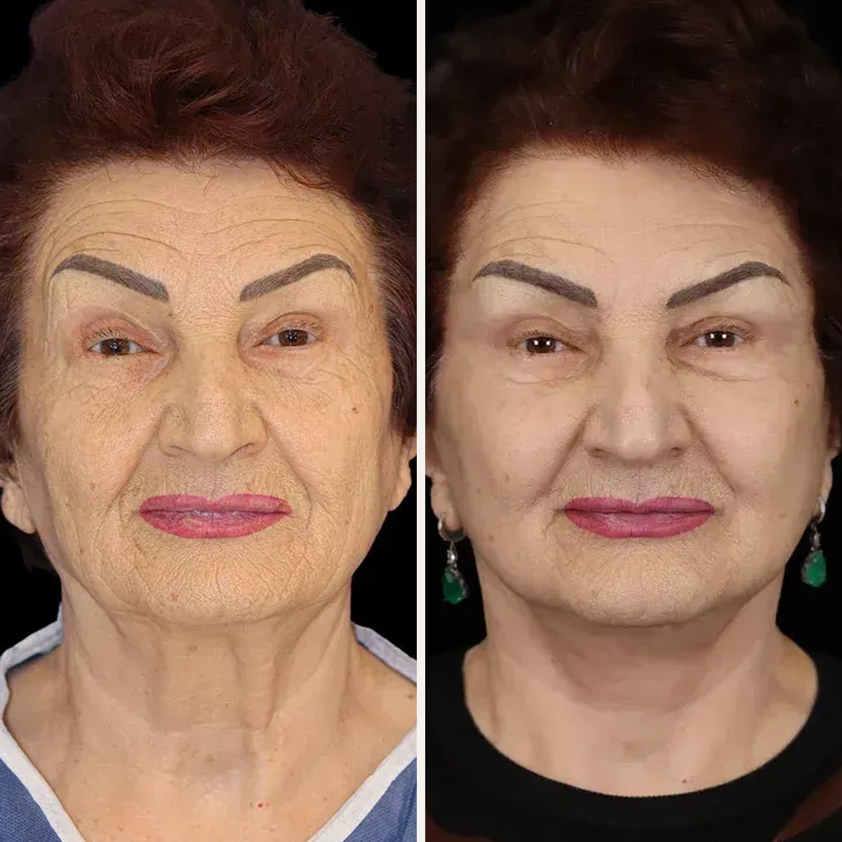 Before and after: Dr. Enio Ilinoiu