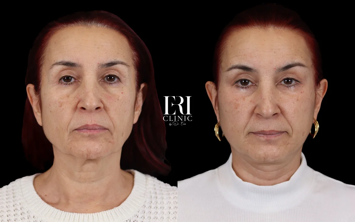 Before and after — Dr. Enio Ilinoiu