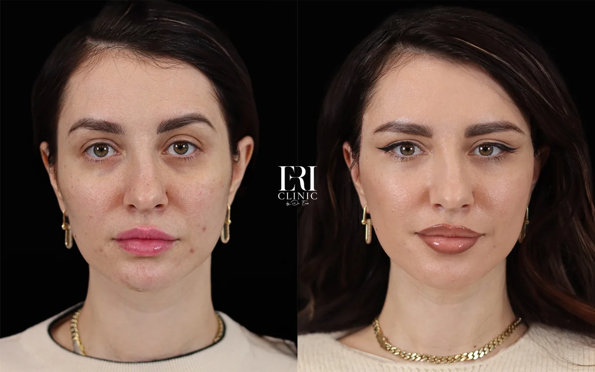 Before and after — Dr. Enio Ilinoiu