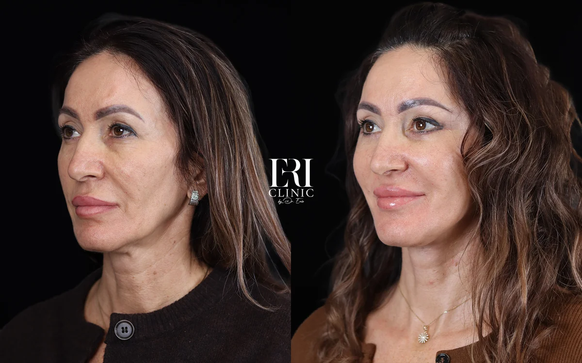 Before and after — Dr. Enio Ilinoiu