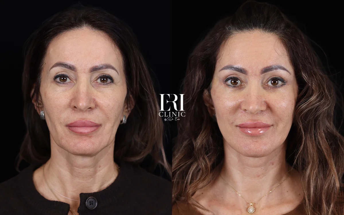 Before and after — Dr. Enio Ilinoiu