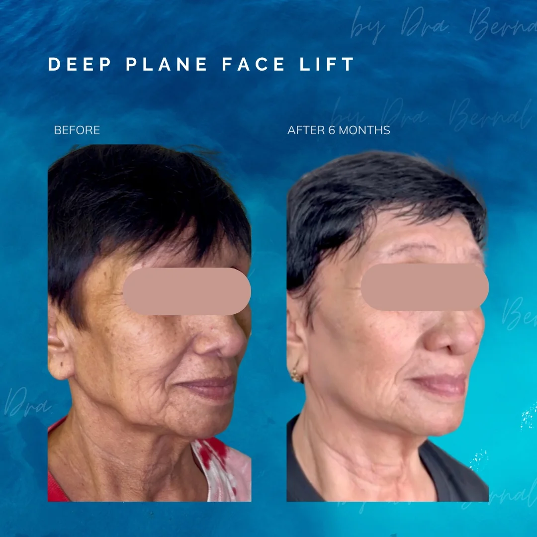 Before and after — Dr. Aicee Bernal