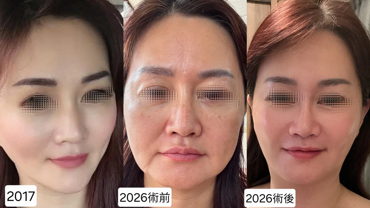 Before and after — Dr. Yu Hsuan Hsieh