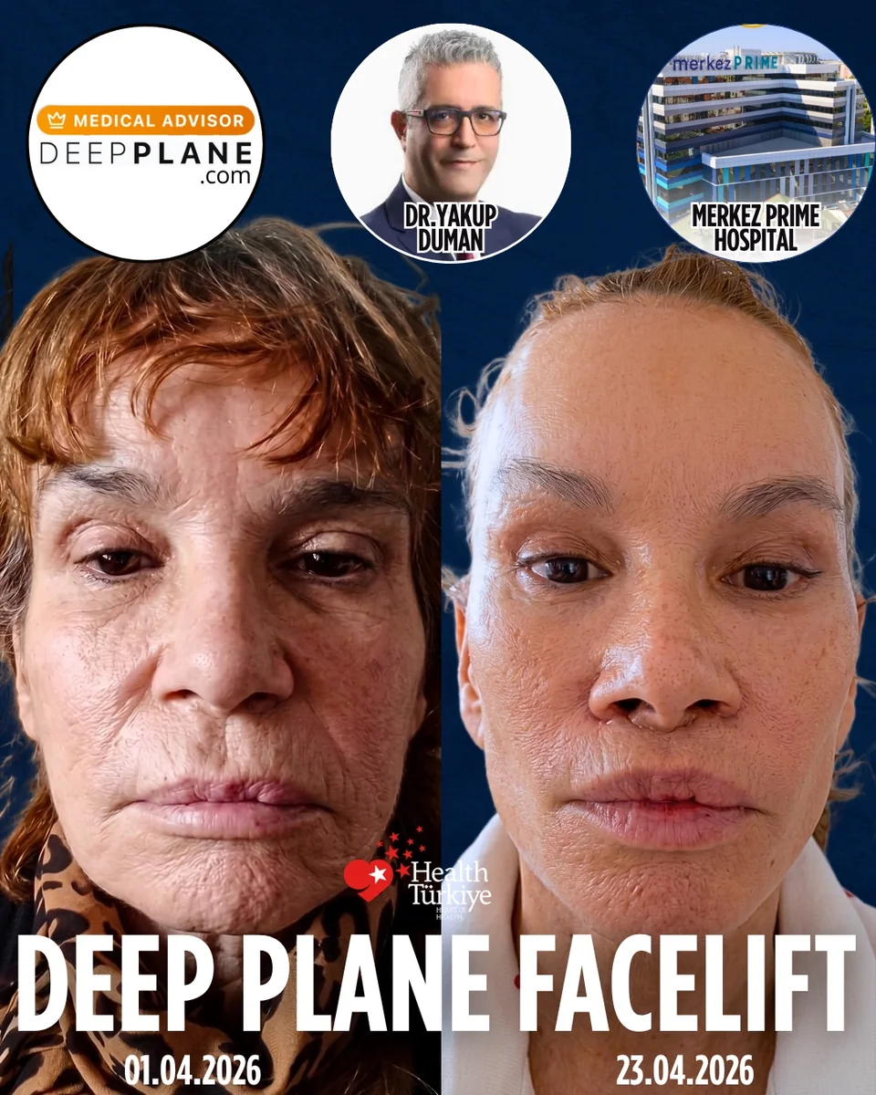 Before and after — Dr. Yakup Duman