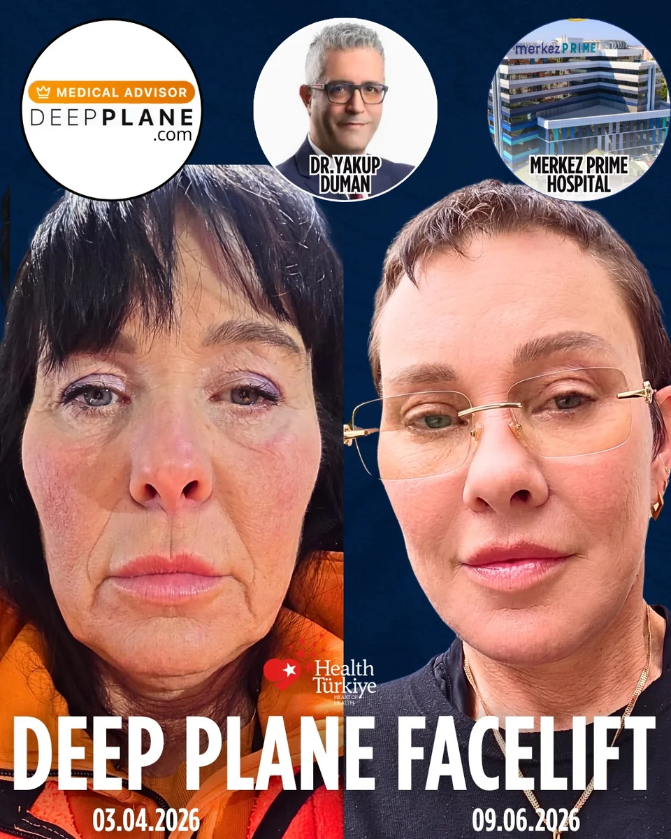 Before and after — Dr. Yakup Duman
