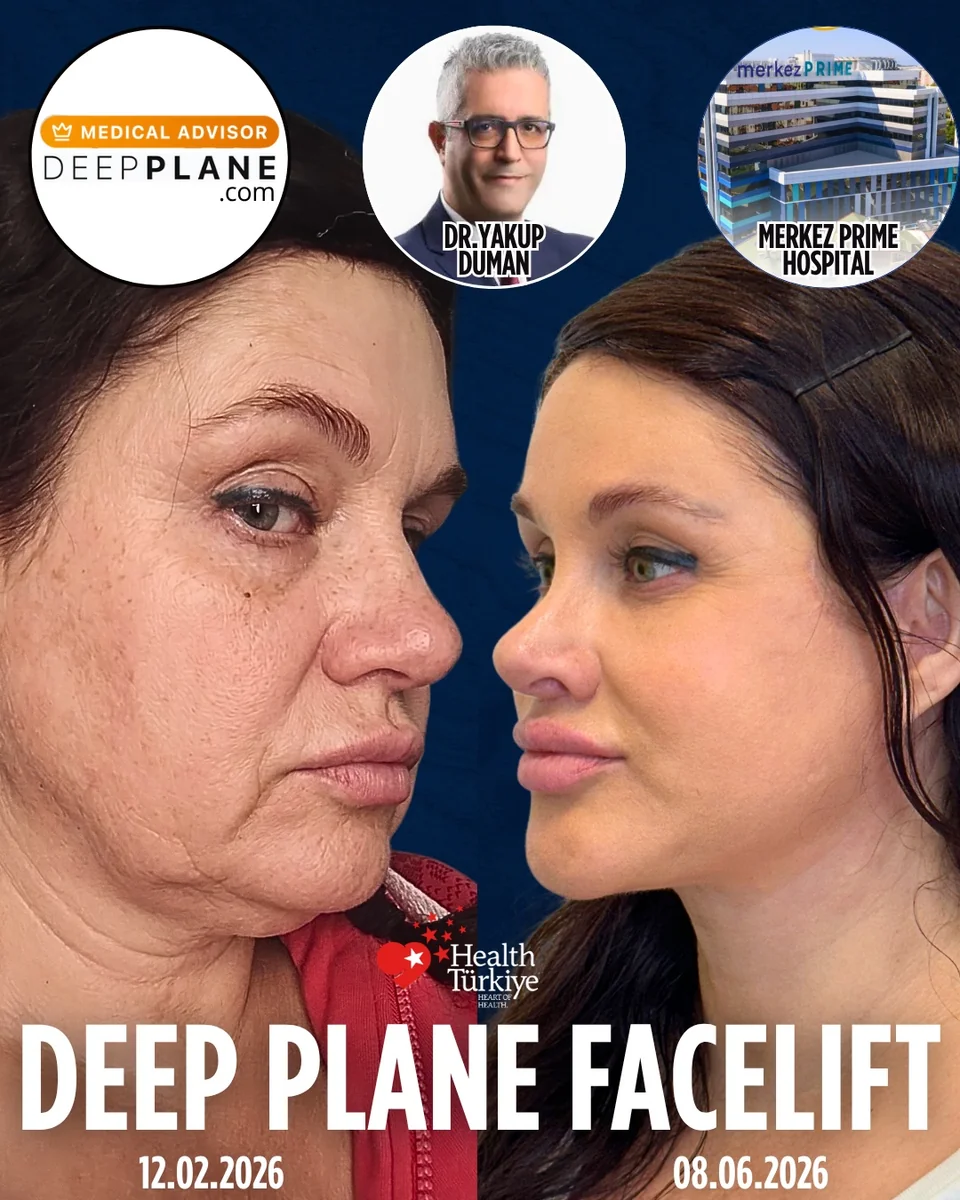 Before and after — Dr. Yakup Duman