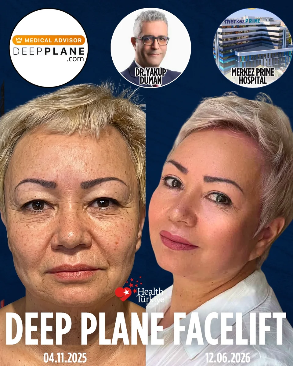 Before and after — Dr. Yakup Duman