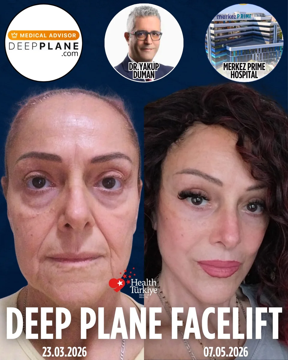 Before and after — Dr. Yakup Duman
